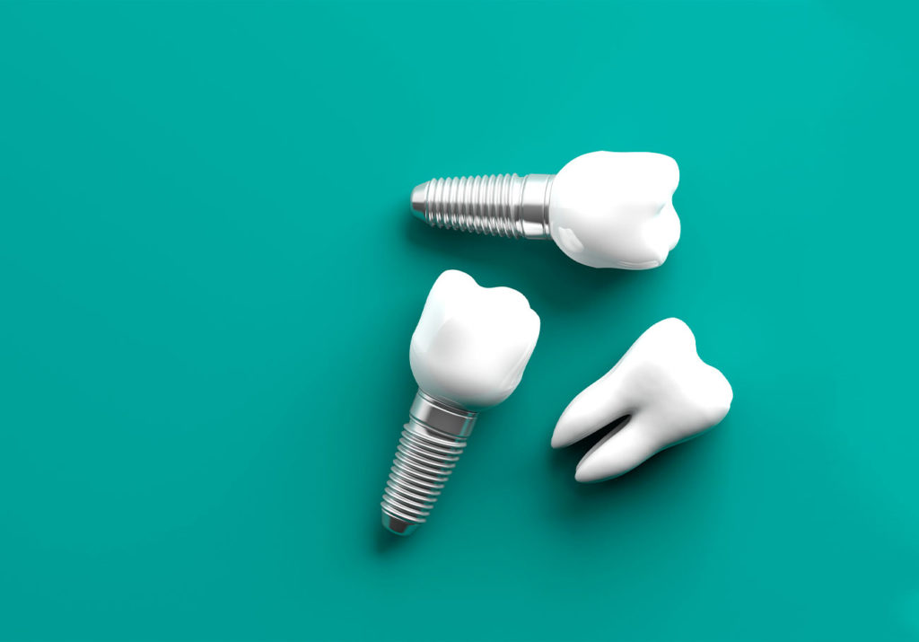 Implants dentaires Marseille - Cabinet dentaire Drs Damiani et Richelme - Dentiste Marseille
